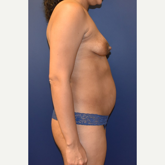 35-44 year old woman treated with Breast Lift with Implants before 3348706