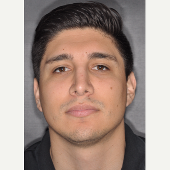 25-34 year old man treated with Septoplasty 3 years post-op after 3814055