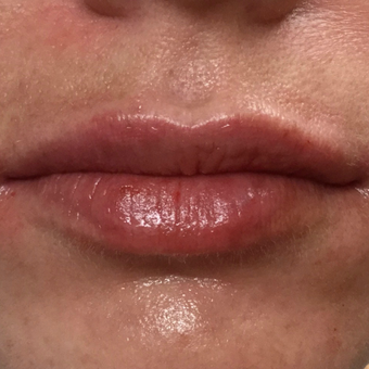 25-34 year old woman treated with Juvederm after 3099048