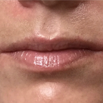 25-34 year old woman treated with Juvederm before 3099048