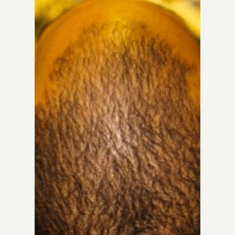 Hair thinning treatment in short hairstyle - non-surgical Hair Regeneration (PRP+ACell) after 2800980