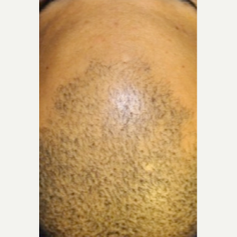 Hair thinning treatment in short hairstyle - non-surgical Hair Regeneration (PRP+ACell) before 2800980