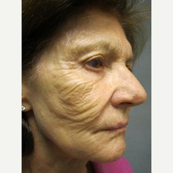 75 and up year old woman treated with Fraxel Repair before 1651286