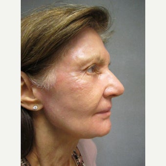 75 and up year old woman treated with Fraxel Repair after 1651286