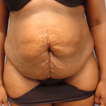 25-34 year old woman treated with Tummy Tuck before 3448189