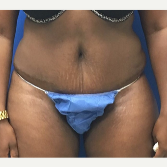 25-34 year old woman treated with Tummy Tuck after 3448189