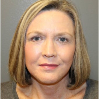 61 year old woman treated with Neck Lift after 1594973