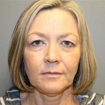 61 year old woman treated with Neck Lift before 1594973
