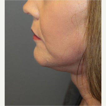 61 year old woman treated with Neck Lift 1594973