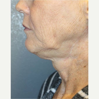 61 year old woman treated with Neck Lift 1594973