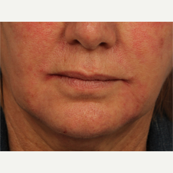 55-64 year old woman treated with Perlane after 3709765