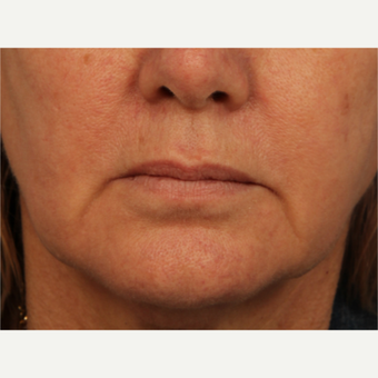 55-64 year old woman treated with Perlane before 3709765
