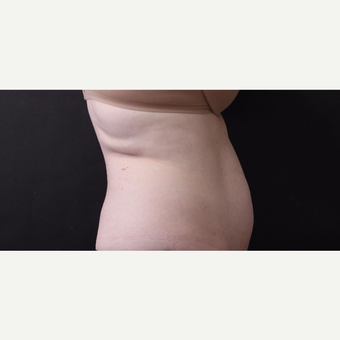 46 year old woman treated with CoolSculpting before 3168911