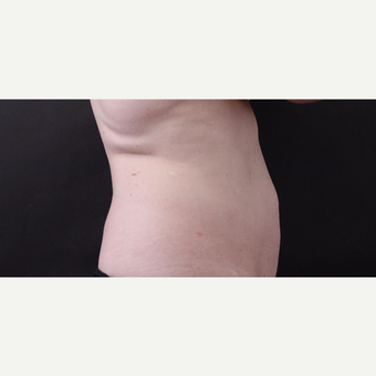 46 year old woman treated with CoolSculpting after 3168911