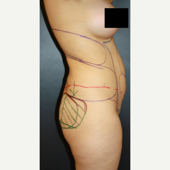 45-54 year old woman treated with Liposculpture before 3055728