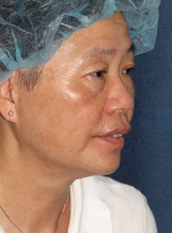 57 year old Asian female with age spots and brown spots after 1058223
