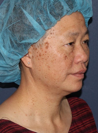 57 year old Asian female with age spots and brown spots before 1058223