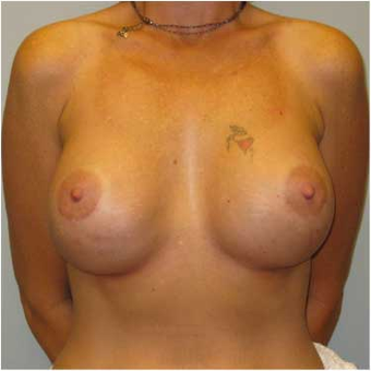 37 year old woman treated with Breast Augmentation after 3468351