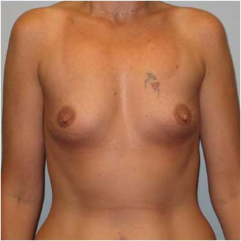37 year old woman treated with Breast Augmentation before 3468351
