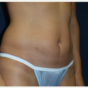 45-54 year old woman treated with Tummy Tuck after 3453698