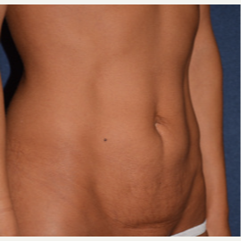 45-54 year old woman treated with Tummy Tuck before 3453698