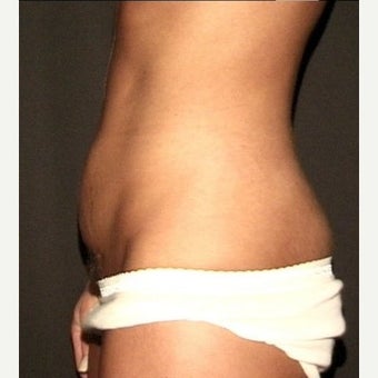 Mini-Tummy Tuck and Abdominal Tumescent Liposuction Result at 2 years in a 35-year old 1550869