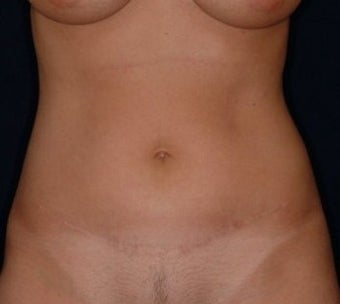 Mini-Tummy Tuck and Abdominal Tumescent Liposuction Result at 2 years in a 35-year old after 1550869