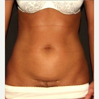 Mini-Tummy Tuck and Abdominal Tumescent Liposuction Result at 2 years in a 35-year old before 1550869