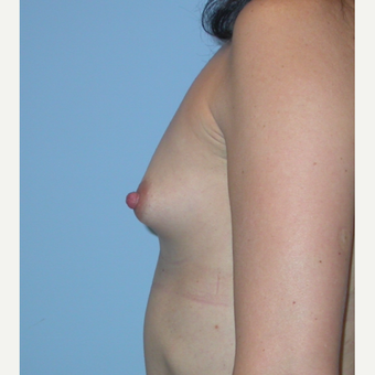 A to B cup. 275 cc moderate profile saline filled to 299 cc. 44 years old. before 3312855