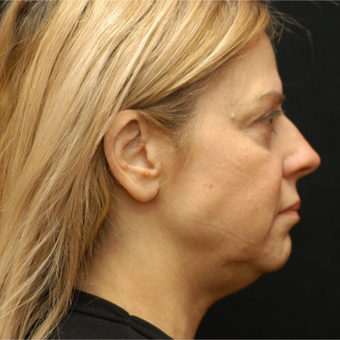 55-64 year old woman treated with Laser Lipo, 5 years later before 3293121