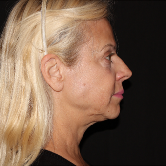 55-64 year old woman treated with Laser Lipo, 5 years later after 3293121