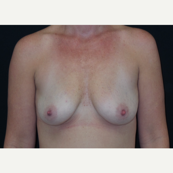 35-44 year old woman treated with Breast Augmentation before 3305033