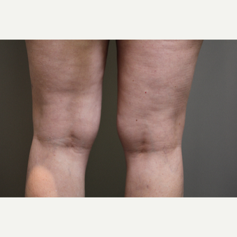 45-54 year old woman treated with Smart Lipo before 3706285