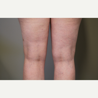 45-54 year old woman treated with Smart Lipo after 3706285