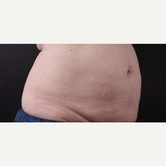 59 year old woman treated with CoolSculpting after 3384625