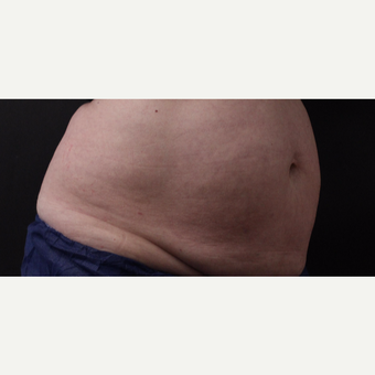 59 year old woman treated with CoolSculpting before 3384625