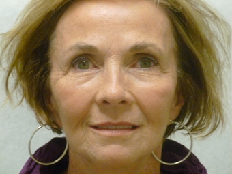 Sculptra for volume loss, 6 months after 4 vials in 65 year old female after 1187716