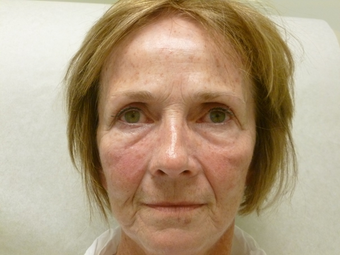 Sculptra for volume loss, 6 months after 4 vials in 65 year old female before 1187716