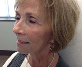 Sculptra for volume loss, 6 months after 4 vials in 65 year old female 1187716