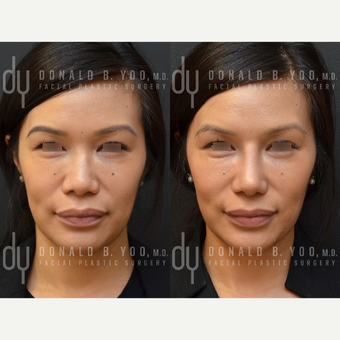 Revision Asian Rhinoplasty before 3477443