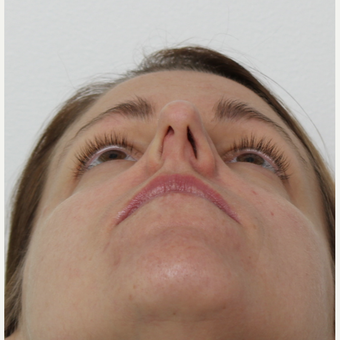 25-34 year old woman treated with Rhinoplasty before 3425596