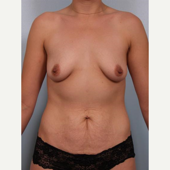 25-34 year old woman treated with Breast Lift with Implants before 3502617
