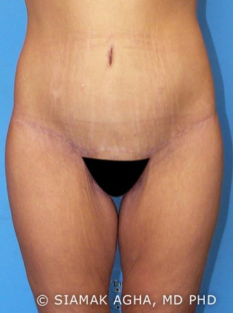 Lower Body Lift after 177449