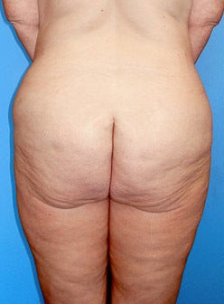 Lower Body Lift 177449