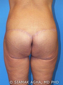 Lower Body Lift 177449
