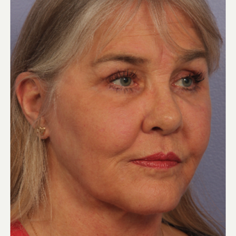 55-64 year old woman treated with Facelift after 3659214