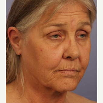 55-64 year old woman treated with Facelift before 3659214