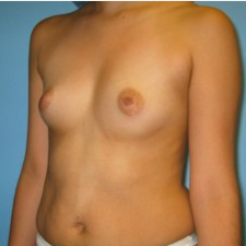 Breast Augmentation before 3665692