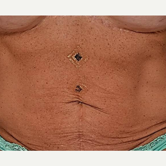 45-54 year old woman treated with Profound RF after 3704158