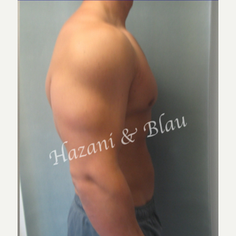 18-24 year old man treated with Male Breast Reduction after 3332944